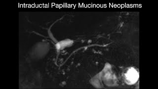 Intraductal Papillary Mucinous Neoplasms [upl. by Valtin994]