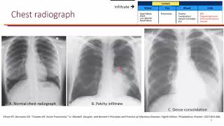 Influenza and CommunityAcquired Pneumonia LO 1 [upl. by Kinnard]