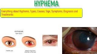 Hyphema Sign Symptoms Causes Risk factor and Treatment Everything is covered in this video [upl. by Iidnarb]