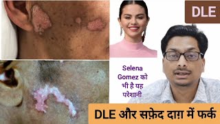 Discoid Lupus Erythematous  DLE और सफ़ेद दाग़ Vitiligo में फर्क  Selena Gomez को है यह परेशानी dle [upl. by Edana]