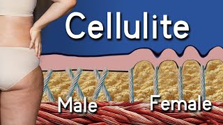 Cellulite Explained Causes Treatments and Prevention Orange Peel [upl. by Adni511]