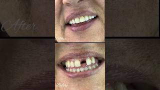 Restoration of Central incisor tooth  Flexible Removable denture shorts dentist [upl. by Coppinger79]