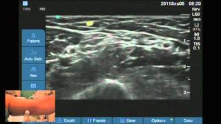 Ultrasound location of Intercostobrachial nerve [upl. by Eyanaj143]