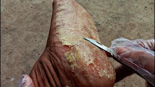 Ultimate Foot Scraping Transformation for an Australian Man [upl. by Mehala692]