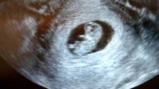 10 weeks pregnant ultrasound [upl. by Maddy]