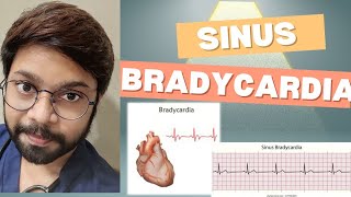 Sinus Bradycardia [upl. by Eadas]