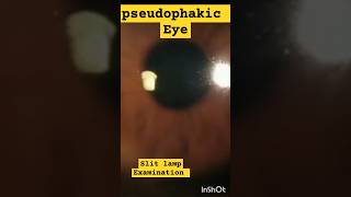 Pseudophakic Eye On Slit Lamp Examination  pseudophakia eyedisease [upl. by Ylremik]