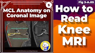 Fig 3A05 Medial Collateral Ligament Anatomy Knee MRI coronal and axial images [upl. by Relda364]