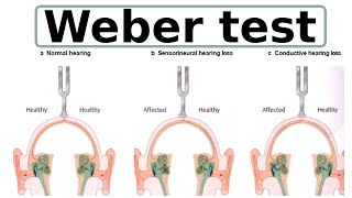 Weber test [upl. by Jarlath195]