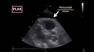 Pericardial Effusion with Doppler Echocardiographic criteria for Tamponade [upl. by Neleag]