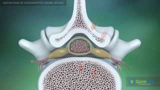 Osteophytes bone spurs Definition [upl. by Luaped697]