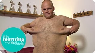 Dibsy Needs Excess Skin Removed After Incredible 19 Stone Weight Loss  This Morning [upl. by Llenral]