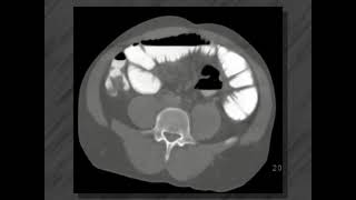 Small bowel disease  Ct enteroclysis [upl. by Santiago37]