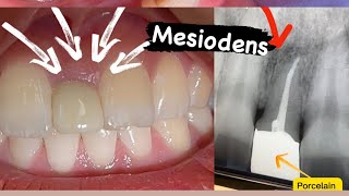 Mesiodens 🦷 [upl. by Jeannette770]