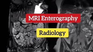 MR Enterography  Small bowel disorde  MRI imaging Radiology [upl. by Philina]