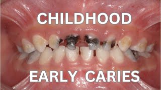 Early Childhood Caries  Rampant Caries [upl. by Maura]