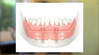 Eine kostengünstige Implantatlösung [upl. by Milburr]