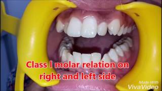 Clinical features of various Malocclusions [upl. by Adnalu]