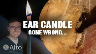 This Ear Candle Makes Hearing WORSE  Ear Wax Removal [upl. by Mikel]