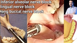 Local Anesthesia Inferior Alveolar Nerve block amp long buccal Nerves block Mandibular nerve block [upl. by Pasadis828]