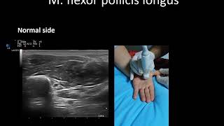 Ultrasound guided M flexor pollicis longus tenosynovitis injection by Prof Murat Karkucak MD [upl. by Whang962]