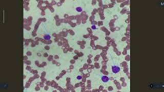 reactive lymphocyte [upl. by Asus]