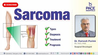 Sarcoma Cancer  Types Diagnosis Treatment amp Prognosis  sarcomatreatment [upl. by Onitnelav639]