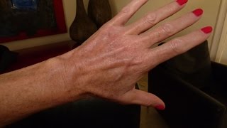 Hand Vein Treatment [upl. by Nawiat63]