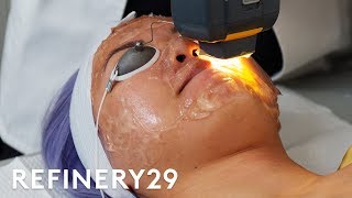 I Got The 65 Laser Facial For Acne  Beauty With Mi  Refinery29 [upl. by Ynnoj]