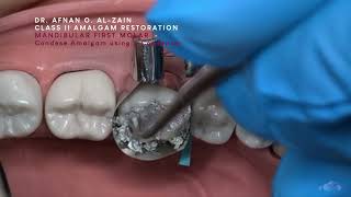 Class II amalgam restoration – Mandibular molar 36  Arabic عربي [upl. by Anatnahs522]