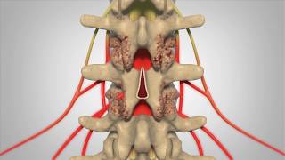 Laminectomy  Patient Education [upl. by Laved]