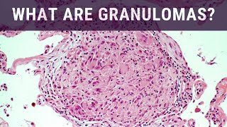 What are Granulomas  Pathology mini tutorial [upl. by Erdnoed233]