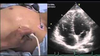 Intro to Echo Apical 4 Chamber Viewmov [upl. by Nnayllek]