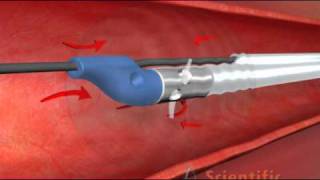 Thrombectomy Catheter  3D Medical Animation [upl. by Laddie]