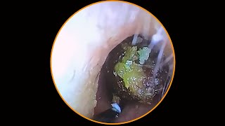 Tympanic membrane perforation and postoperative debridement for cholesteatoma 44 [upl. by Laban]