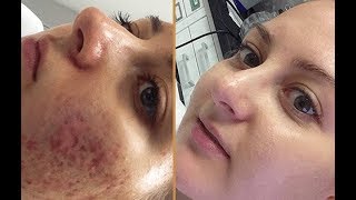 Tretin 0025 For Remove Pimple Holes and Pimples Black Marks Review Hindi [upl. by Thorin]