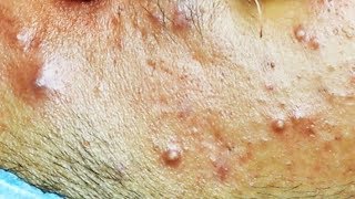 Extraction dacné kystique et pustule  cystic acne [upl. by Ecnarolf816]