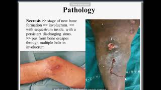 Chronic Osteomyelitis [upl. by Ysteb819]