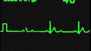 2nd Degree 21 AV Block  ECG Simulator  Arrhythmia Simulator [upl. by Reeve]