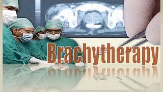 Brachytherapy and classification of brachytherapy  Radiation therapy  Radiation Physics xray [upl. by Eelyam]