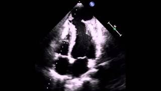 Pesudoaneurysm of left ventricle due to myocardial abscess [upl. by Nira]