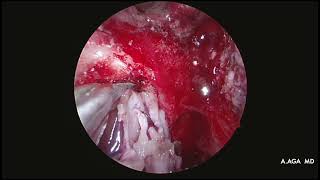 Intracranial Esthesioneuroblastoma  three layer reconstruction 2 fascia lata and pericranial flap [upl. by Letreece]