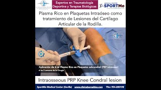 PRP INTRAÓSEO LESION CARTILAGO RODILLA TIBIA Intraosseous PRP Knee Condral lesion Dr Bernáldez [upl. by Hsiri]