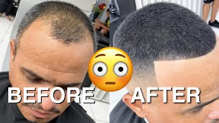 BEFORE amp AFTER From being BALD to FULL HEAD OF HAIR [upl. by Sternberg]