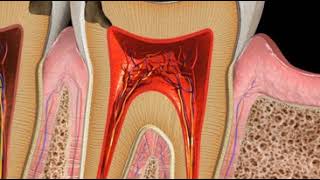 Decay Interproximal [upl. by Plate604]