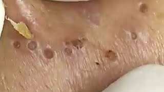 Blackheads amp Whiteheads Satisfying Removal 0066 [upl. by Aerdnahs]