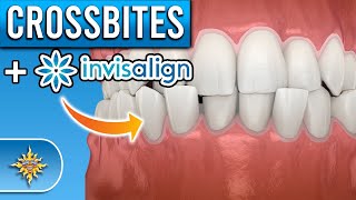 Can Invisalign Fix Crossbites [upl. by Alleuol]