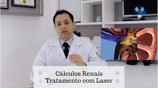 Pedras nos rins  Tratamento com Laser [upl. by Krishna]