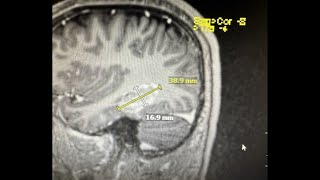 Laser ablation surgery helps treat young mans epilepsy [upl. by Ellingston]