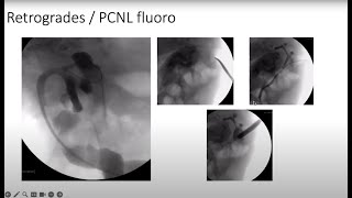 Case Report Complex Stone Disease With a Complex Anatomy [upl. by Tomkins328]